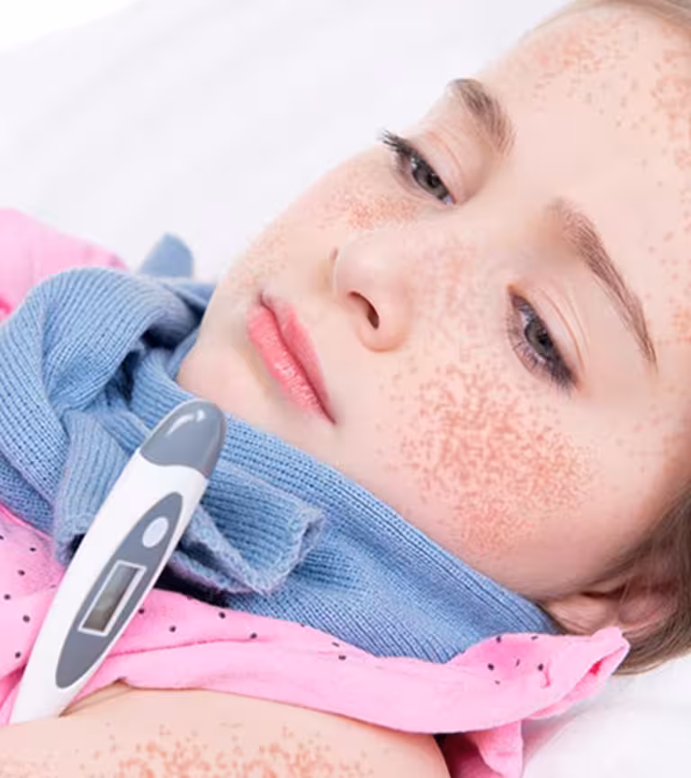 Scarlet Fever In Children Causes, Symptoms And Treatment