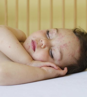 Serious Symptoms Of Chicken Pox In Toddlers