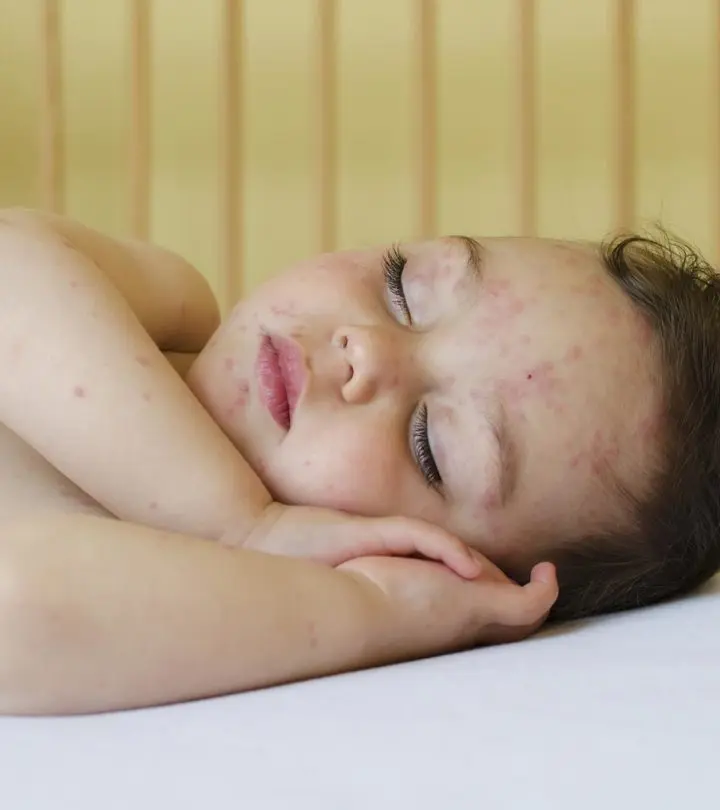 Serious Symptoms Of Chicken Pox In Toddlers