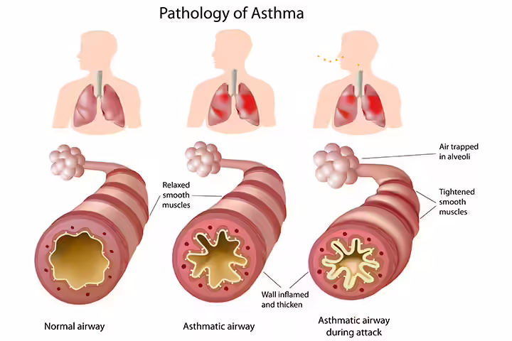 What Is Asthma What Is Asthma