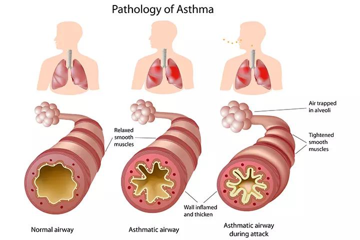 What Is Asthma