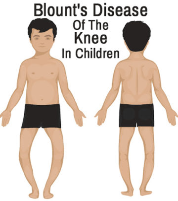 Blount Disease In Children – Symptoms And Treatment