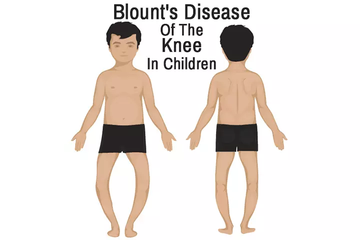 Blount Disease In Children – Symptoms And Treatment_image