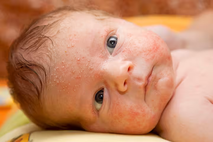 Baby Burn burn on a baby
