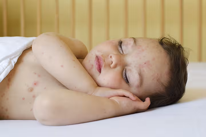 Chickenpox In Toddlers chicken pox in toddler