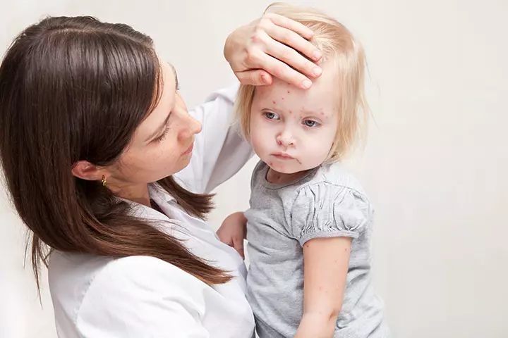 Measles In Toddlers – 3 Causes, 9 Symptoms & 8 Treatments_image