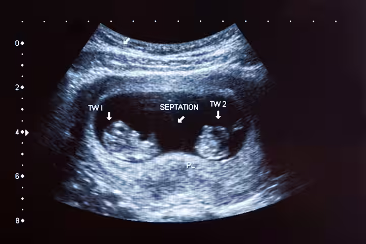 Twin Pregnancy Scans scans to monitor twins