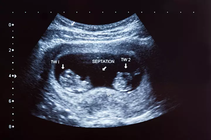 4 Pregnancy Scans To Monitor Growth Of Twins_image