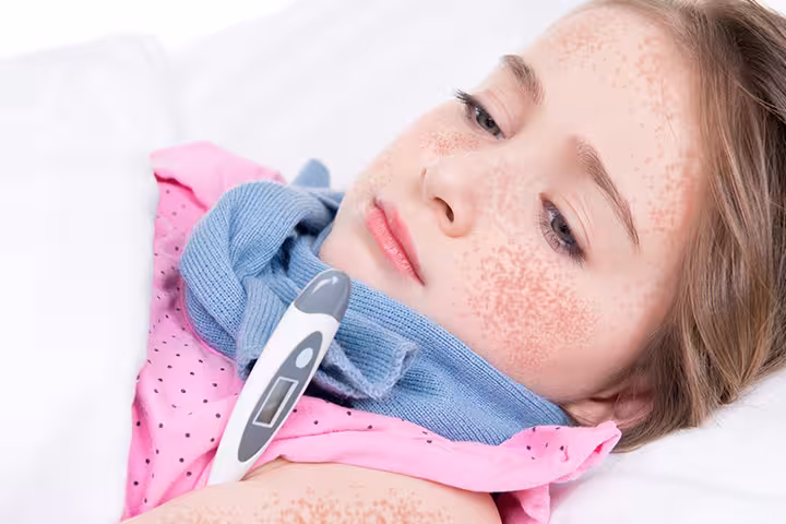 Scarlet Fever In Children scarlet fever in children