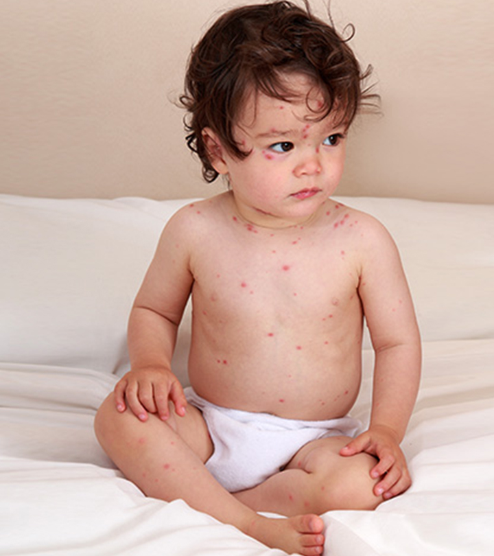 Hives In Toddlers – 5 Causes, 5 Symptoms & 3 Treatments You Should Be Aware Of_image