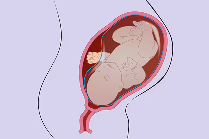 Amniotic Band Syndrome Amniotic Band Syndrome