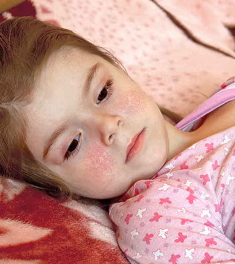 Fifth-Disease-In-Children-Causes-Symptoms-And-Treatment