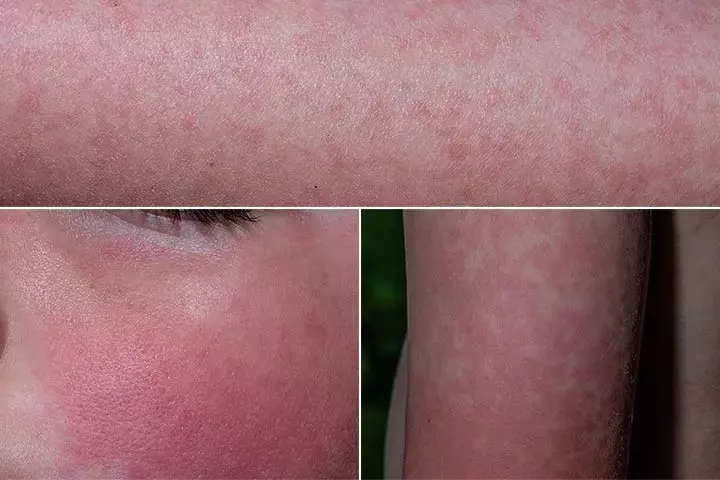 Fifth Disease Rash Pictures