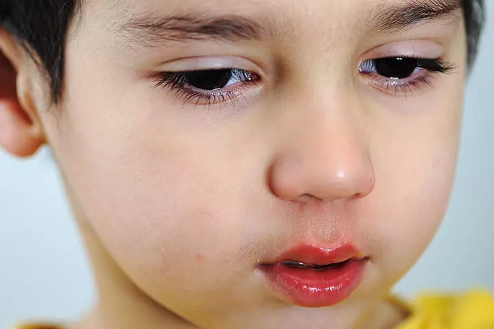 Shellfish Allergy In Kids – 4 Types, 6 Symptoms And 6 Precautions_image