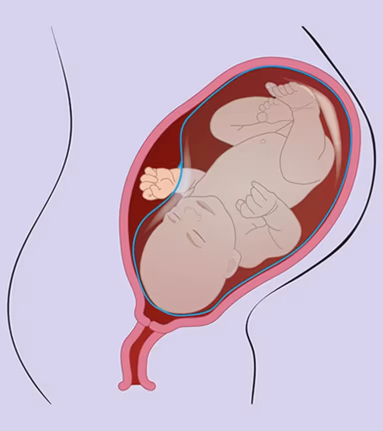 What Is Amniotic Band Syndrome & What Are Its Causes