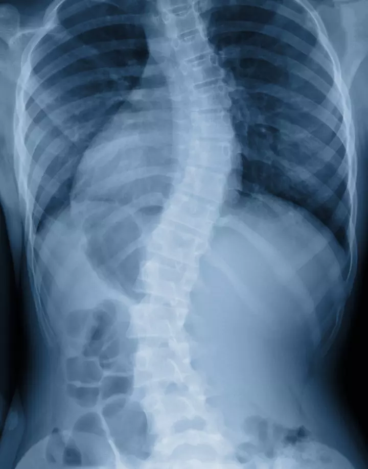 Diagnosis Of Scoliosis