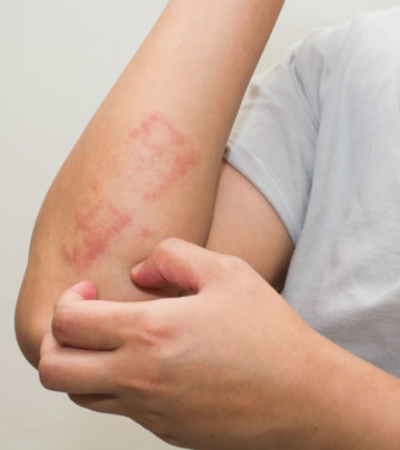 6 Ways To Use Apple Cider Vinegar For Treating Psoriasis