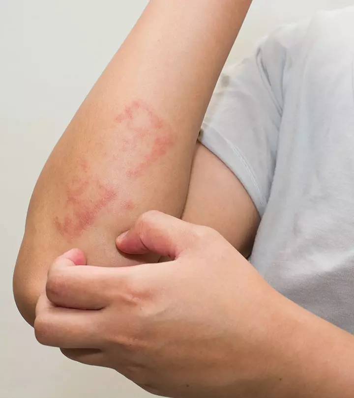 6 Ways To Use Apple Cider Vinegar For Treating Psoriasis