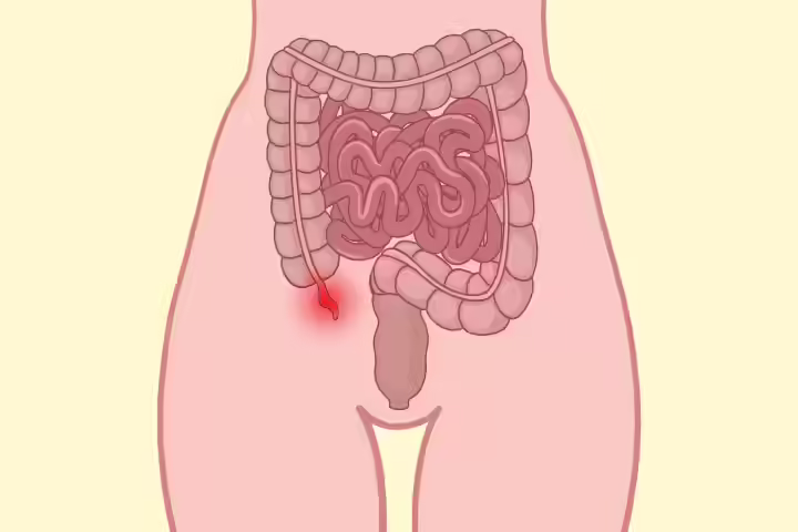 Appendicitis During Pregnancy Appendicitis During Pregnancy