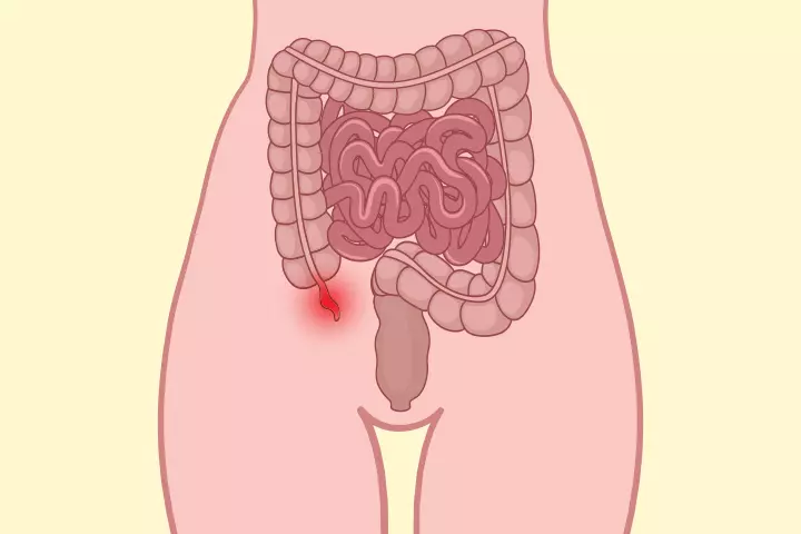 Appendicitis During Pregnancy