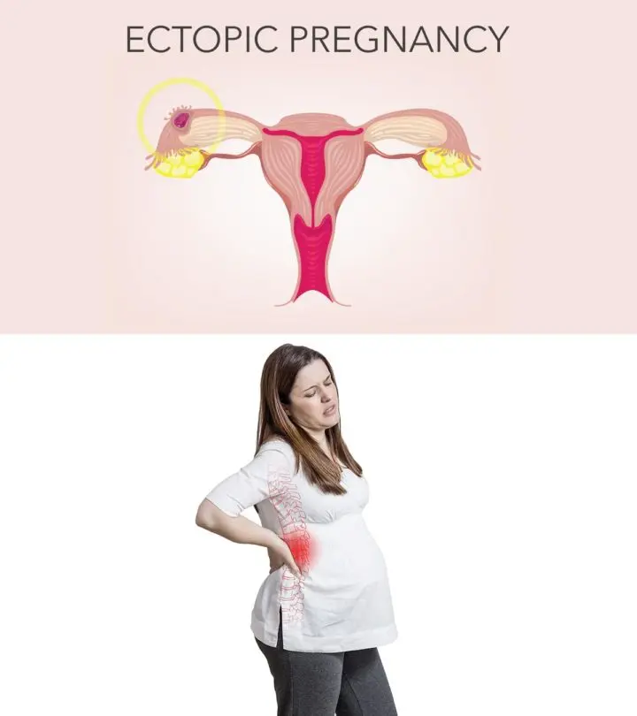 Ectopic Pregnancy - Causes, Symptoms And Treatments You Should Be Aware Of