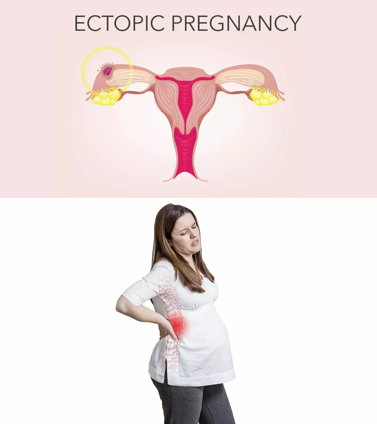 Ectopic Pregnancy – Causes, Symptoms And Treatments You Should Be Aware Of_image