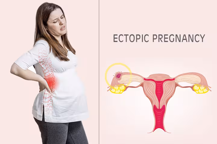 Ectopic Pregnancy