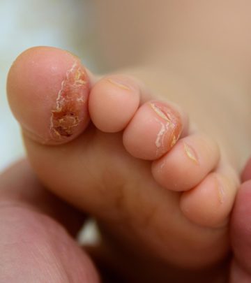 Psoriasis In Babies Symptoms, Causes Treatment You Should Know