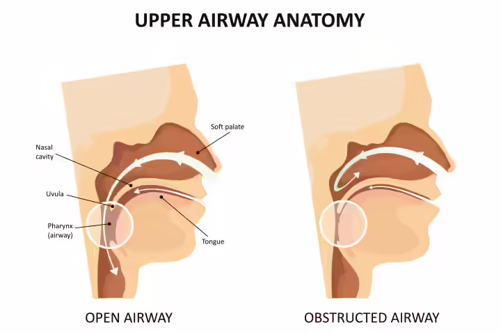 Types Of Sleep Apnea