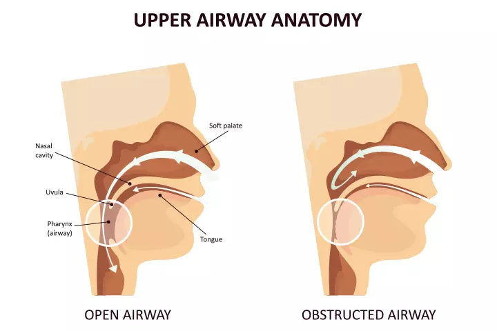 Types Of Sleep Apnea