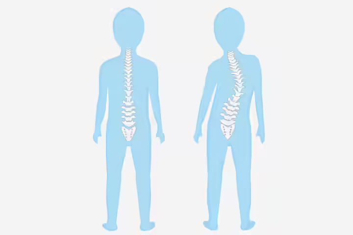 What Is Scoliosis