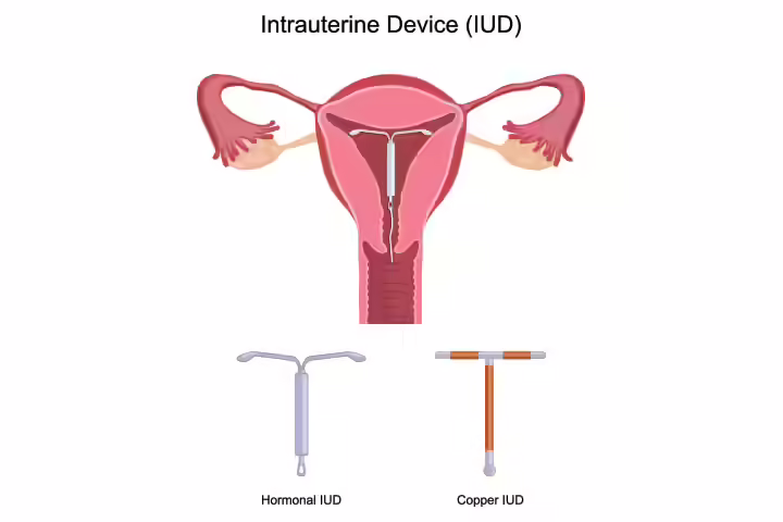 11-Best-Birth-Control-Methods-While-Breastfeeding-1