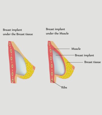 Breastfeed With Implants