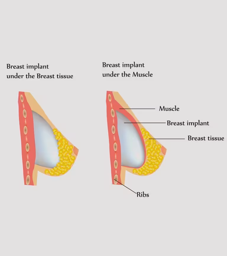 Breastfeed With Implants