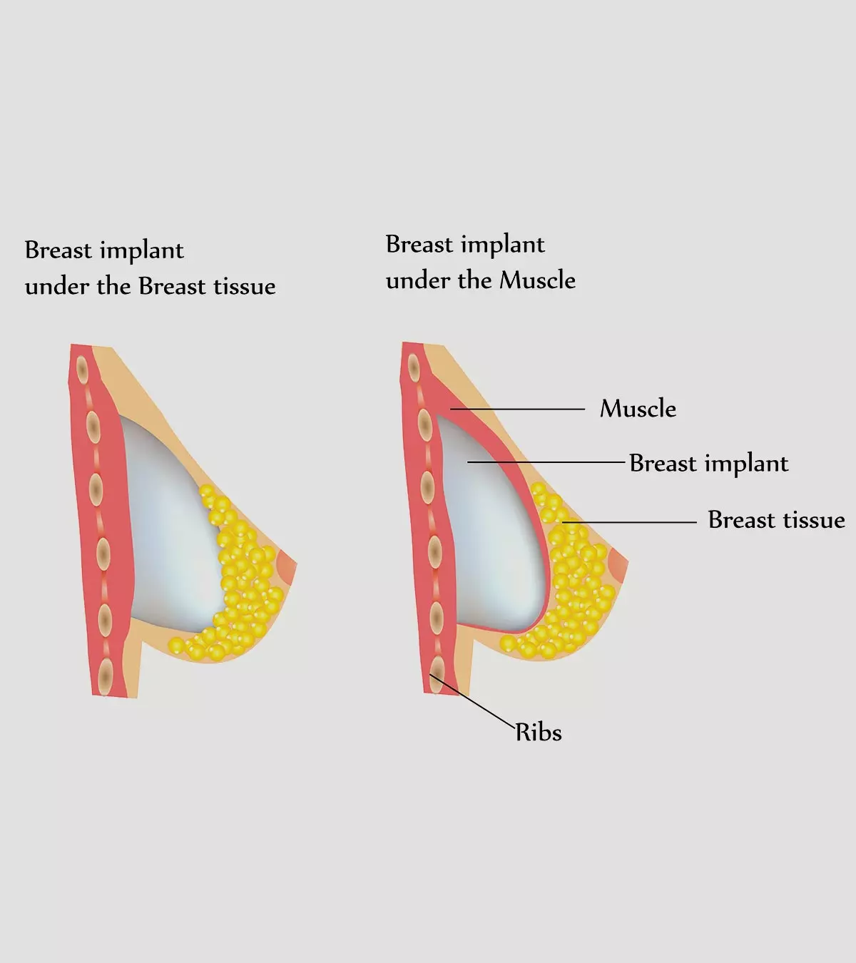 Ability to breastfeed after the procedure depends on the size and place of the implant and the type of augmentation procedure.