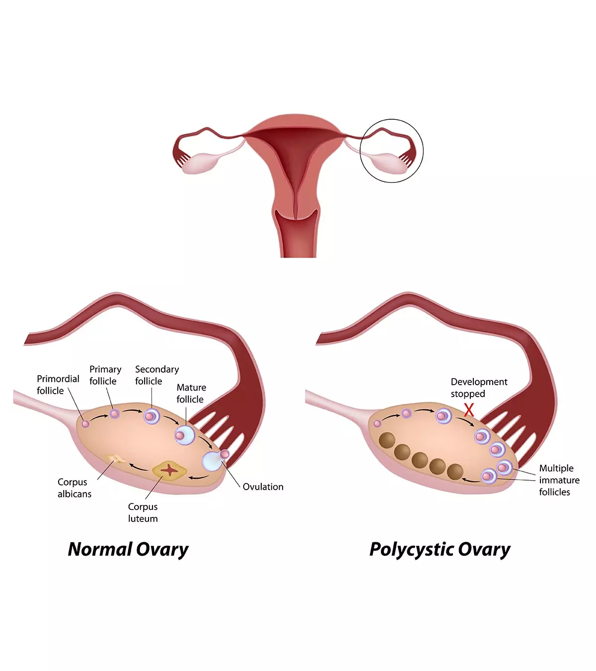 Do Ovary Cysts Affect Pregnancy?_image