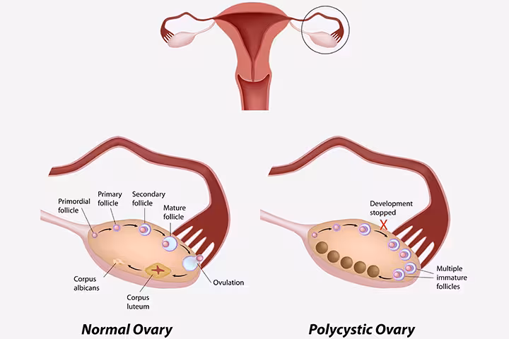 Can Ovarian Cysts Affect Pregnancy Do Ovary Cysts Affect Pregnancy