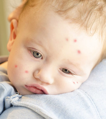 4 Effective Home Remedies To Treat Insect Bites In Babies/Infants