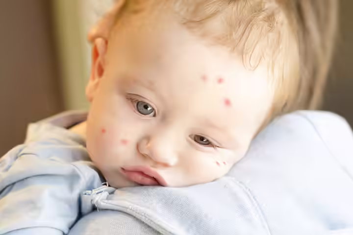 Insect Bites In Babies Insect Bites In Babies