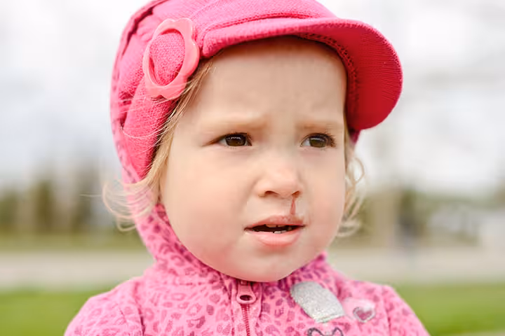 Nosebleed In Toddlers Nose Bleed In Toddlers