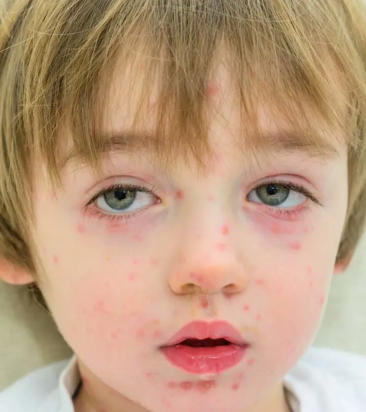 Papular Urticaria In Children Causes, Symptoms Treatment