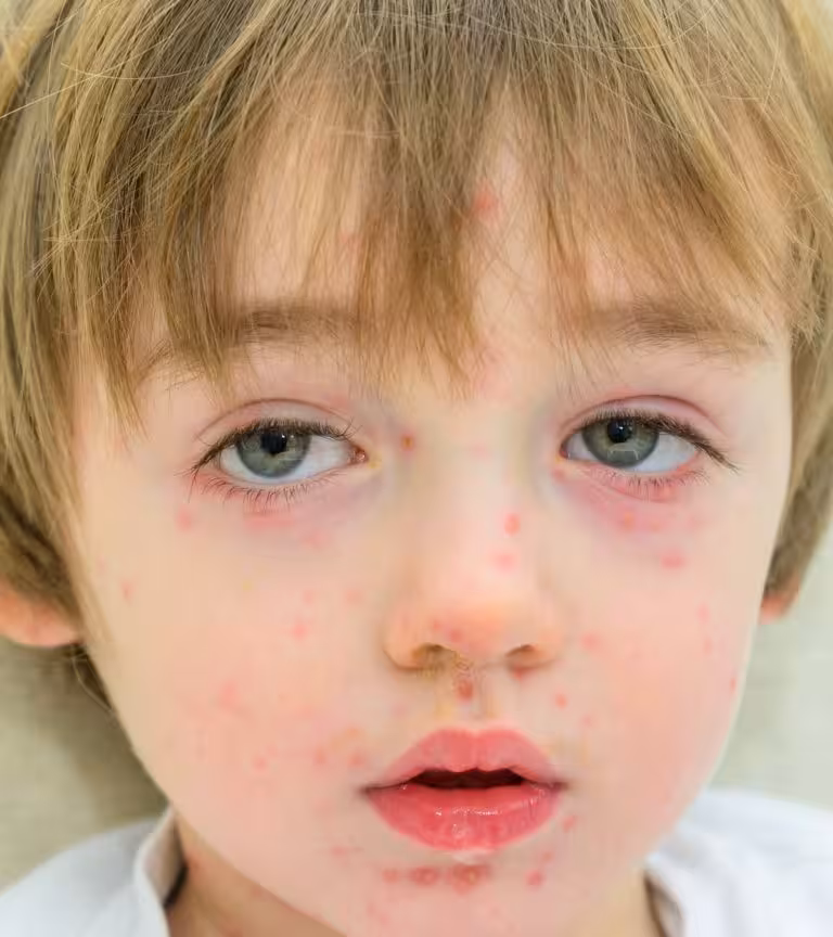 Papular Urticaria In Children Causes, Symptoms Treatment