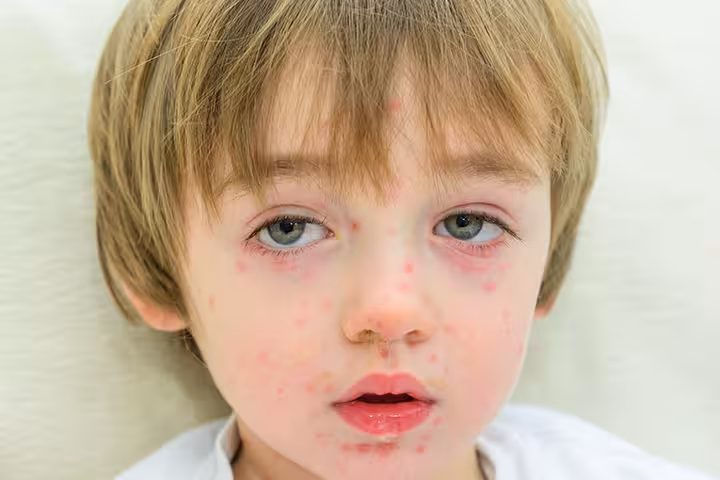 Papular Urticaria Papular Urticaria