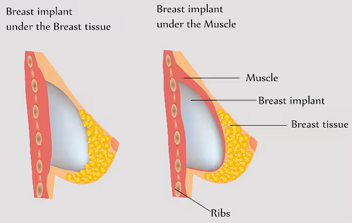 Things To Keep In Mind While Breastfeeding After Breast Augmentation