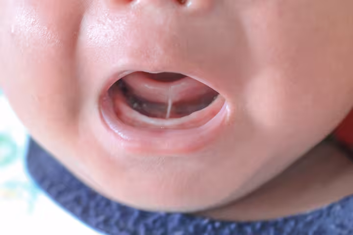 Tongue Tie In Babies