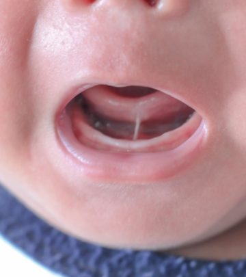 Tongue Tie In Babies Causes, symptoms And Treatment