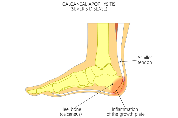 What Is Sever’s Disease