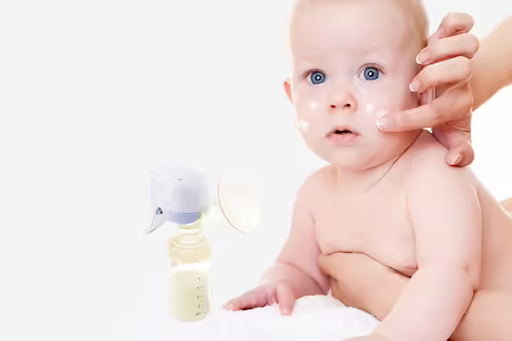 Breast Milk To Treat Baby Acne Acne In Babies