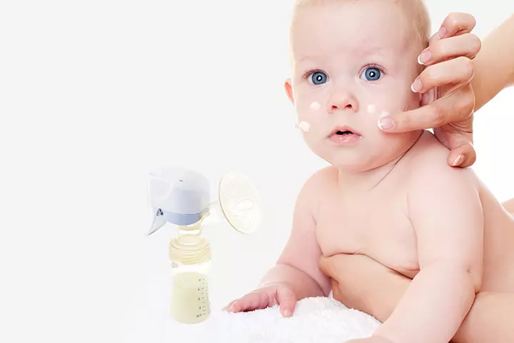 Is Breast Milk Effective To Treat Acne In Babies?_image