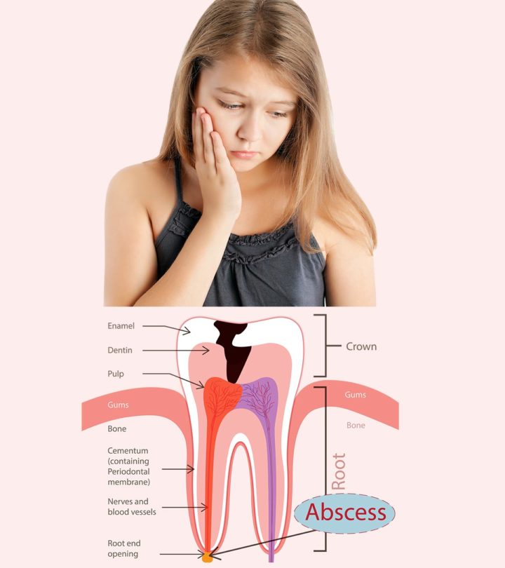 Abscessed Tooth In Children Causes, Symptoms And Treatment